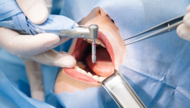 Implanți Dentari