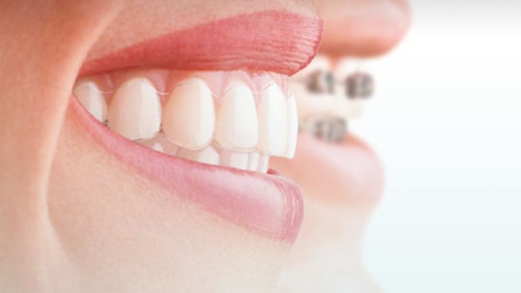 Ce este mai bine – brackeți sau aligners?
